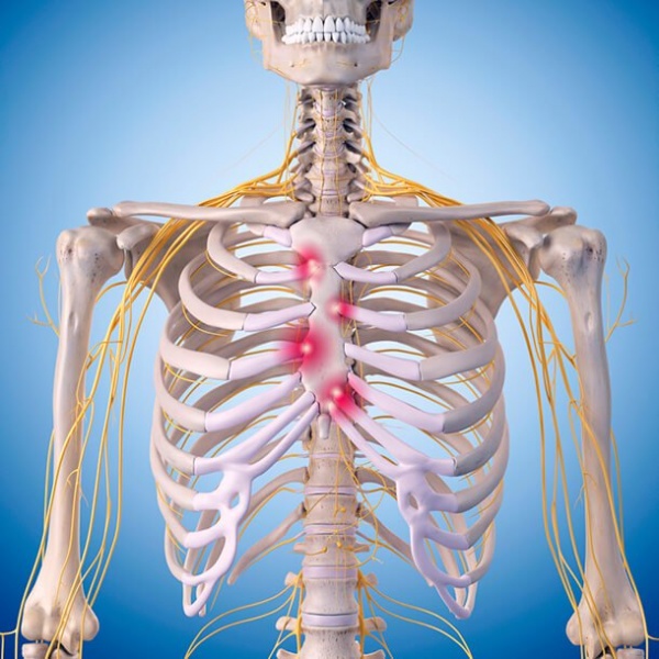 Costochondritis Physiopedia   600px Costochondritis 